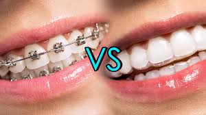 Braces and invisible aligners in adilabad