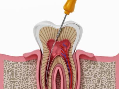 best root canal treatment in adilabad