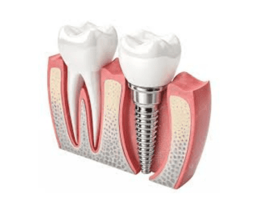 Dental Implants in Adilabad | Dr Arun Dental Clinic-Best Dental Clinic in Adilabad