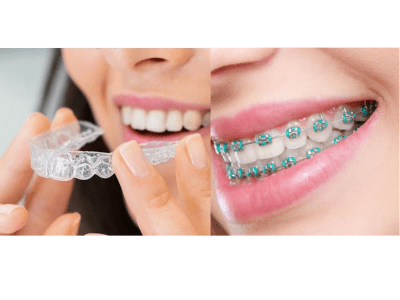 Dr Arun Dental Clinic,  Aligners provider in Adilabad