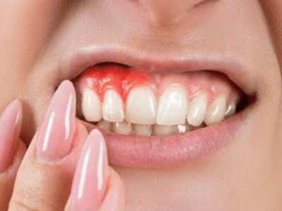 Gum Care & Bleeding Gums Treatment in Adilabad At Dr Arun Dental Clinic, Adilabad