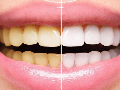 Teeth Whitening & Cleaning Specialist Doctor in Adilabad | Dr Arun Dental Clinic

 
